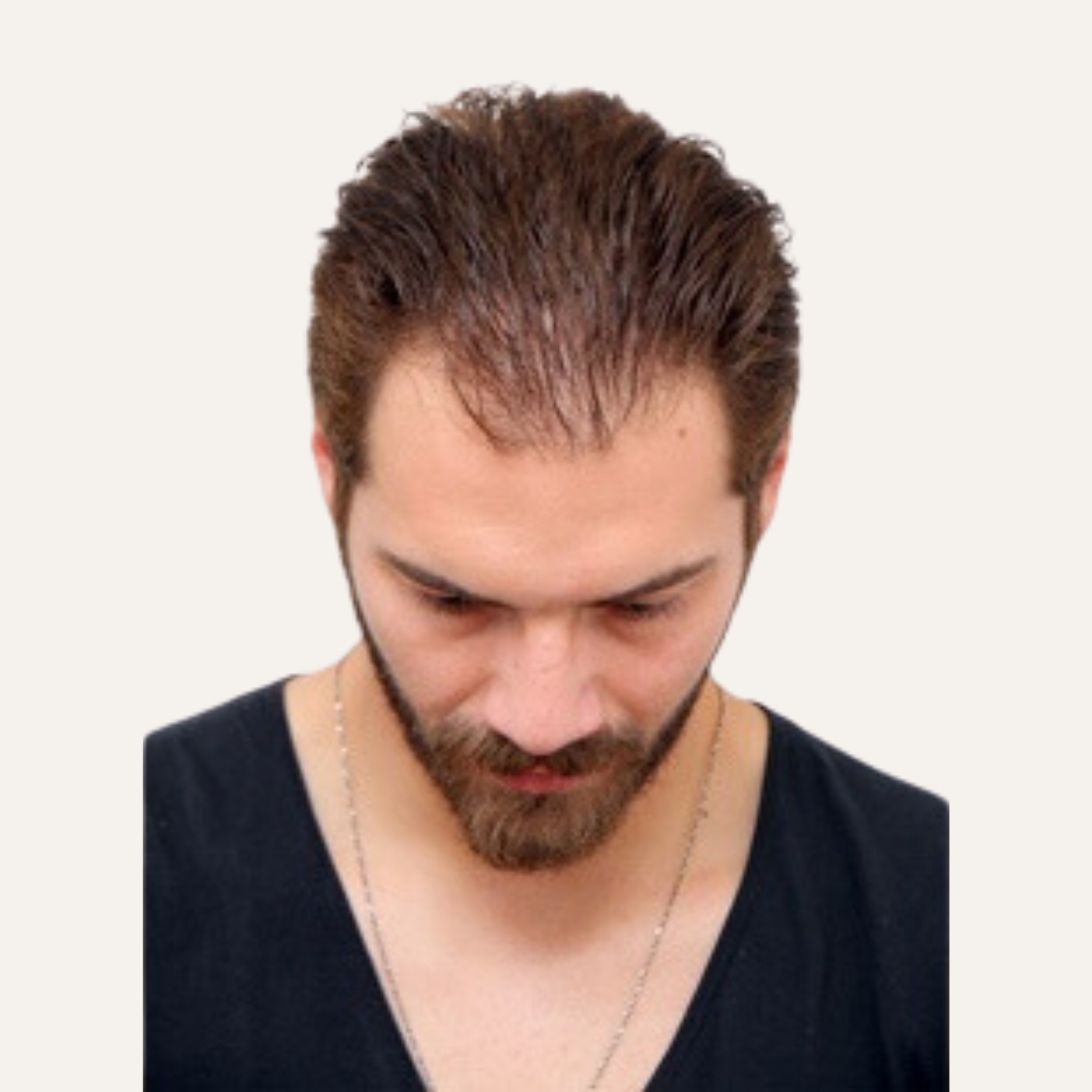 Hair Transplant